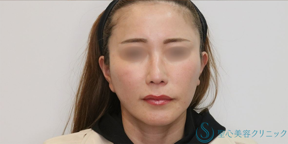 【40代女性・長期的なリフトアップ】フェイスリフト＋脂肪吸引（頬＋顎下）＋リガメント処理（3ヶ月後） After 名古屋+フェイスリフト　小顔