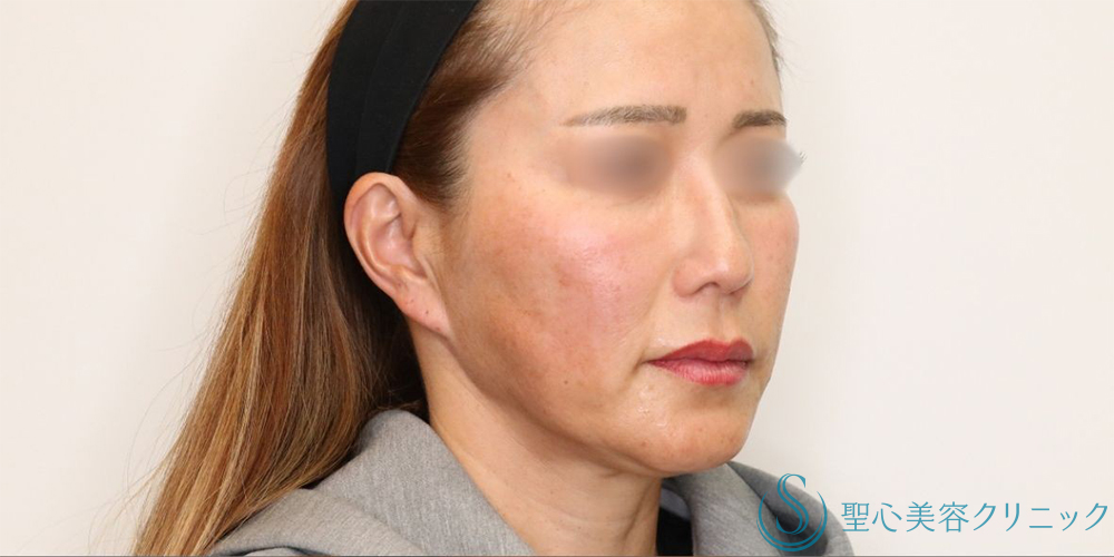 【40代女性・長期的なリフトアップ】フェイスリフト＋脂肪吸引（頬＋顎下）＋リガメント処理（3ヶ月後） Before 名古屋+フェイスリフト　小顔