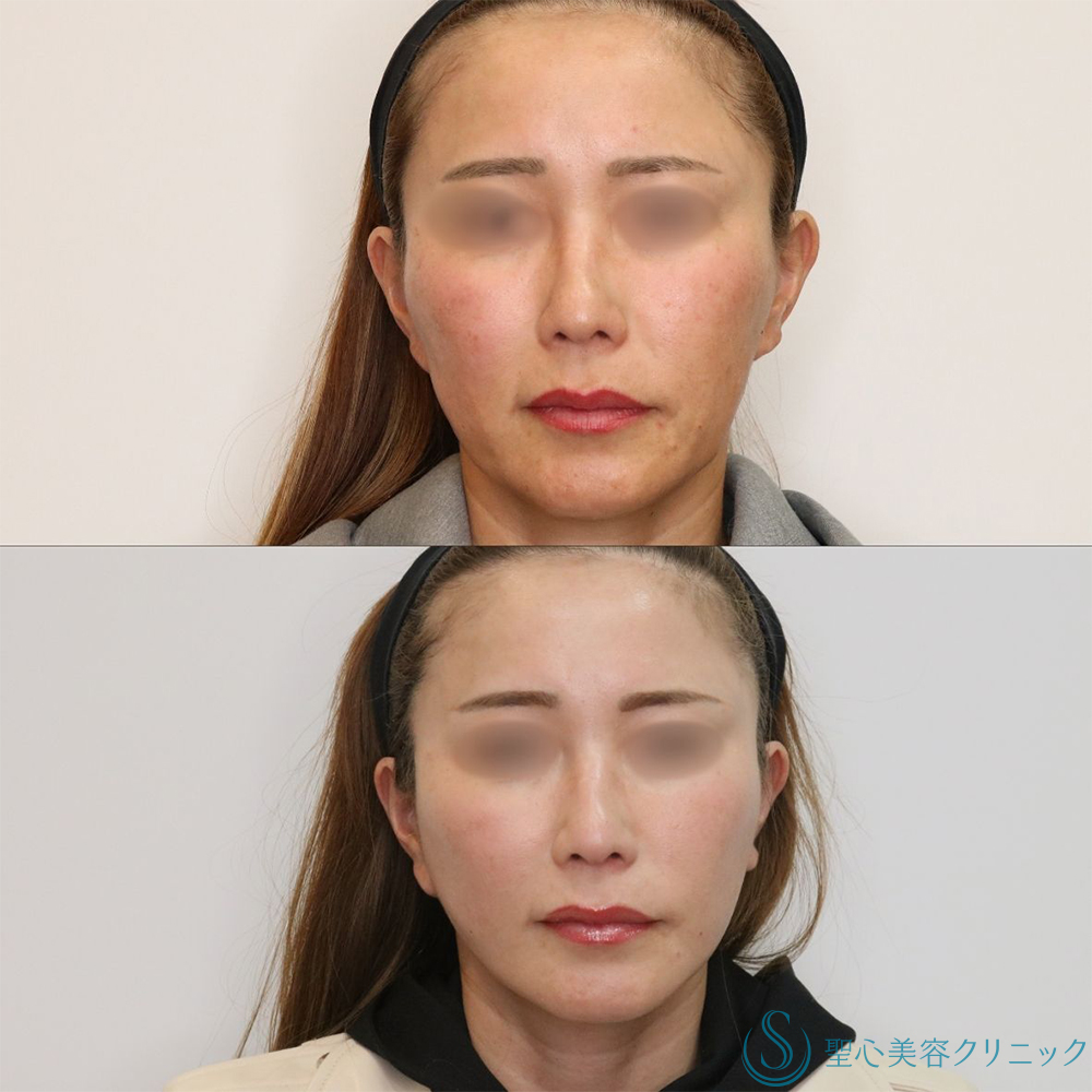 【40代女性・長期的なリフトアップ】フェイスリフト＋脂肪吸引（頬＋顎下）＋リガメント処理（3ヶ月後） After 名古屋+フェイスリフト　小顔