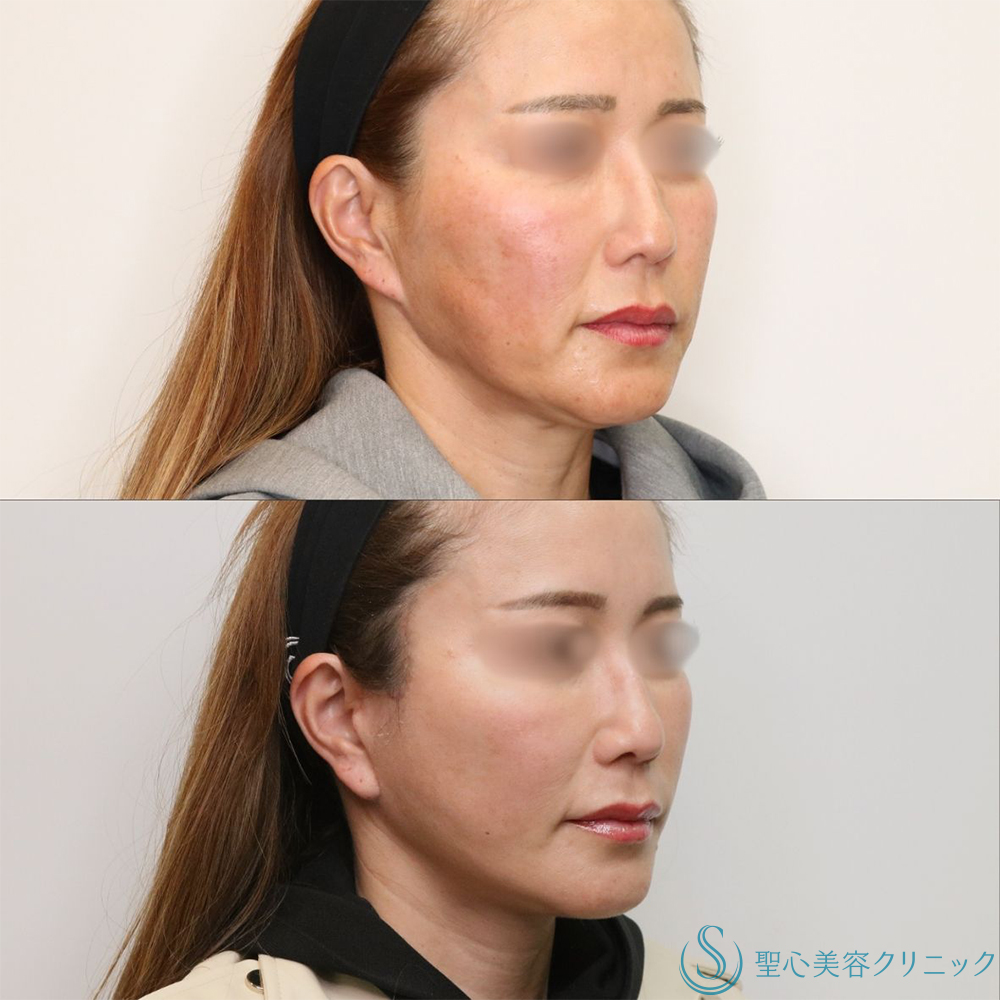 【40代女性・長期的なリフトアップ】フェイスリフト＋脂肪吸引（頬＋顎下）＋リガメント処理（3ヶ月後） After 名古屋+フェイスリフト　小顔