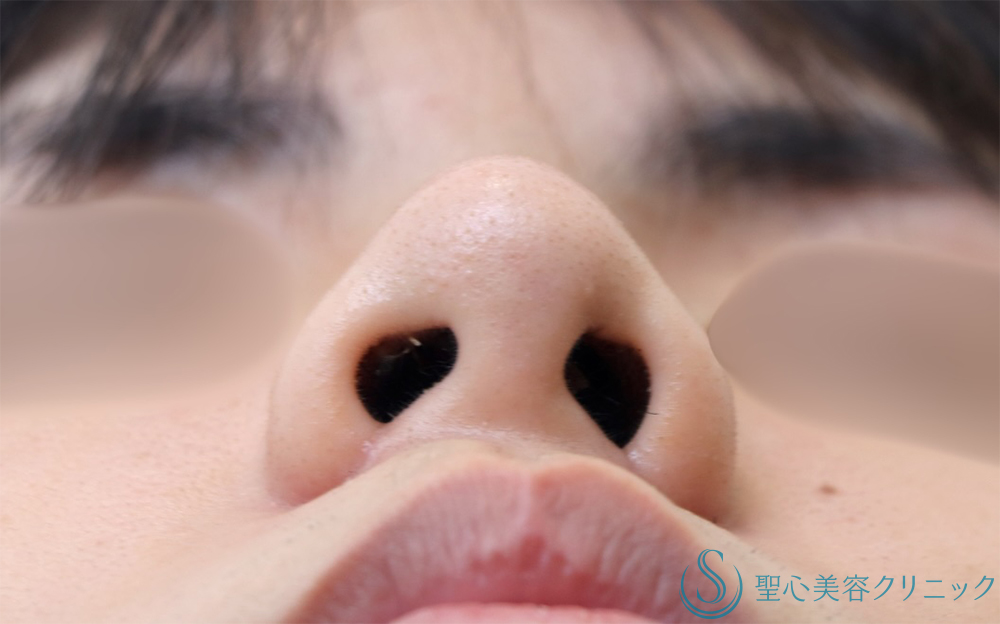 【20代男性・鼻の複合手術で自然に小さく】　小鼻縮小＋鼻尖縮小＋鼻尖形成（耳介軟骨移植）（1ヶ月後） After 