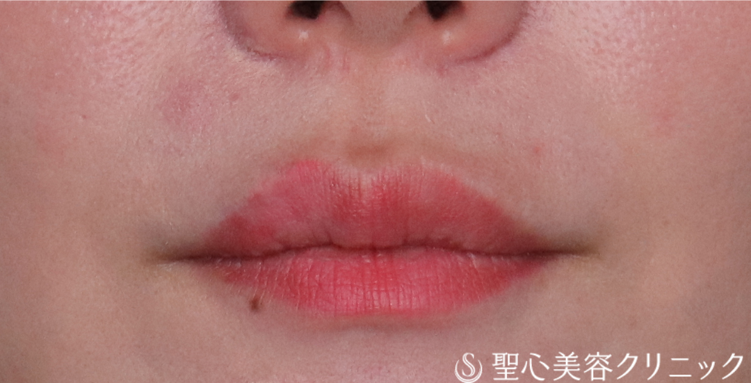 【30代女性・ふっくらハリのある口元に】ヒアルロン酸注入（唇）（直後〜2週間後） Before 