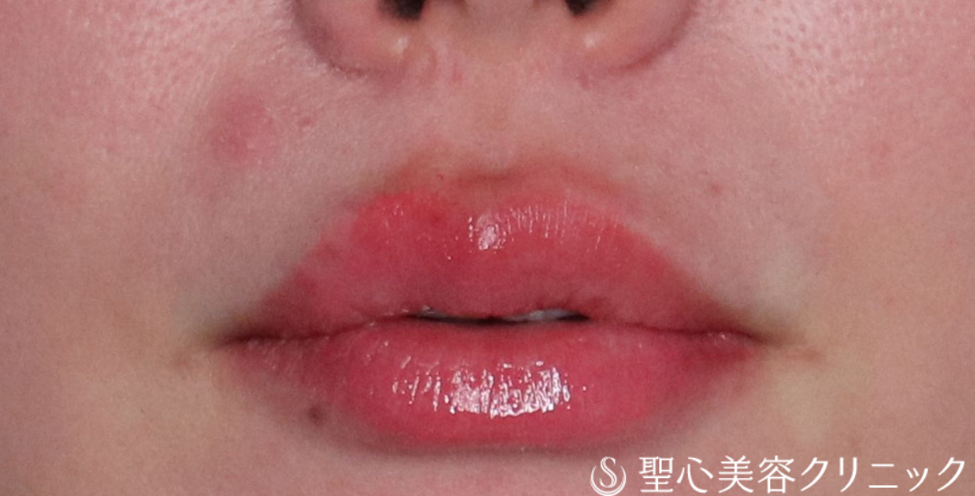【30代女性・ふっくらハリのある口元に】ヒアルロン酸注入（唇）（直後〜2週間後） After 