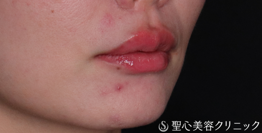 【30代女性・ふっくらハリのある口元に】ヒアルロン酸注入（唇）（直後〜2週間後） After 