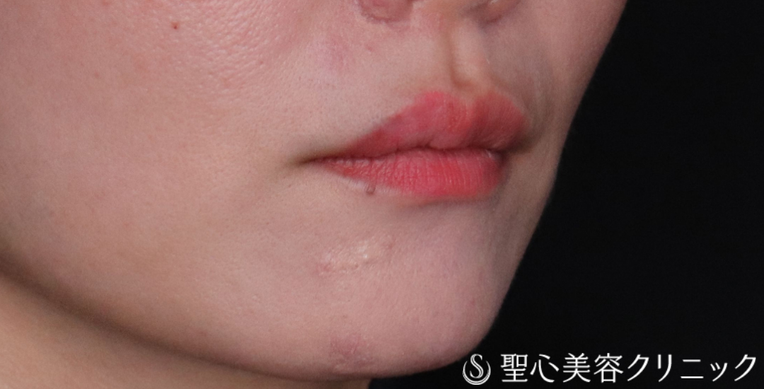 【30代女性・ふっくらハリのある口元に】ヒアルロン酸注入（唇）（直後〜2週間後） Before 