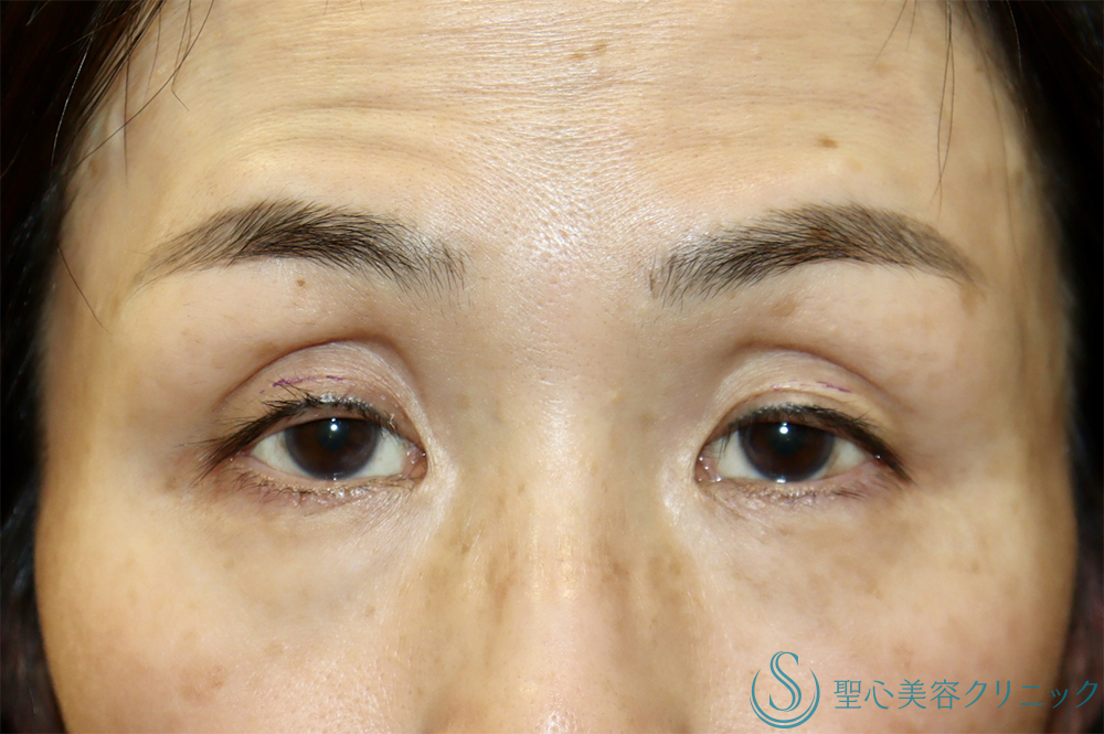 【50代女性・目の上のくぼみ】眼瞼下垂（切開法/腱膜縫縮法）（1週間後・１ヶ月後） Before 