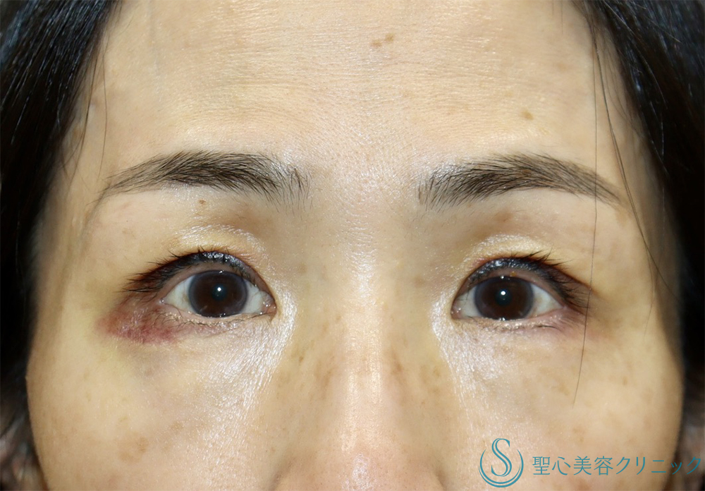【50代女性・目の上のくぼみ】眼瞼下垂（切開法/腱膜縫縮法）（1週間後・１ヶ月後） After 