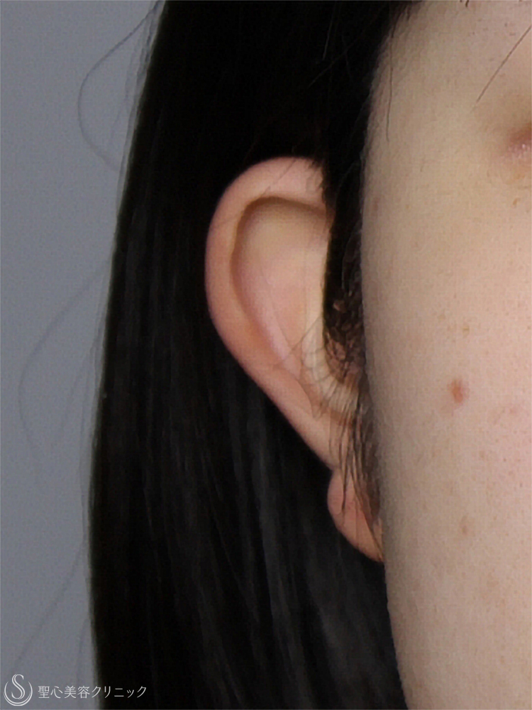 【20代女性・立ち耳を改善】立ち耳修正（切開法）（1ヶ月後） Before 