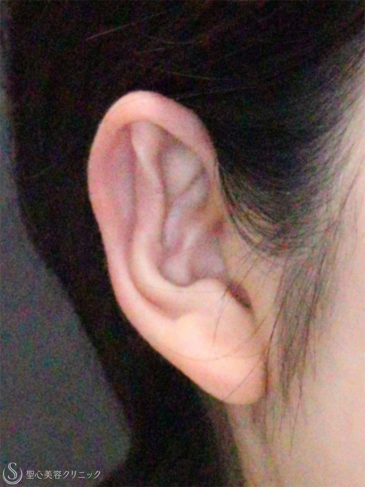 【20代女性・立ち耳を改善】立ち耳修正（切開法）（1ヶ月後） After 