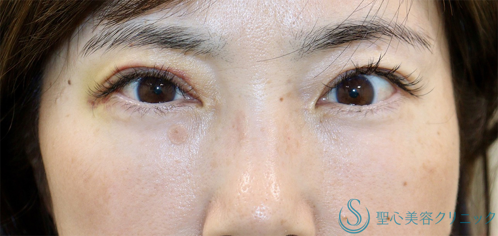 【40代女性・目の上のくぼみ】眼瞼下垂（切開法/腱膜縫縮法）（1週間後・3ヶ月後） After 