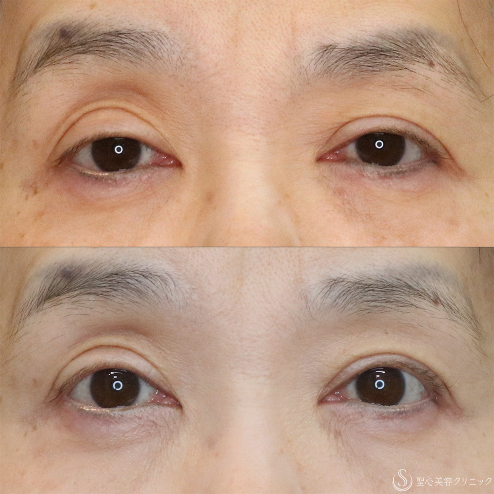 【50代女性・切らずに目の開き改善】眼瞼下垂埋没法（1ヶ月後） After 名古屋+眼瞼下垂　埋没法