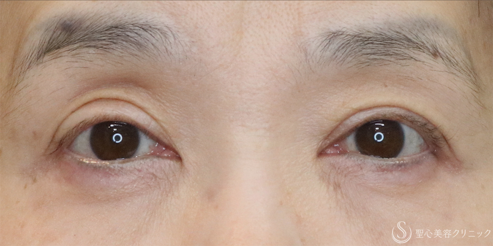 【50代女性・切らずに目の開き改善】眼瞼下垂埋没法（1ヶ月後） After 名古屋+眼瞼下垂　埋没法