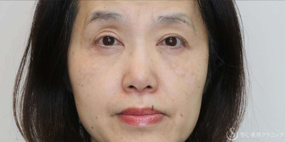【50代女性・切らずに目の開き改善】眼瞼下垂埋没法（1ヶ月後） After 名古屋+眼瞼下垂　埋没法