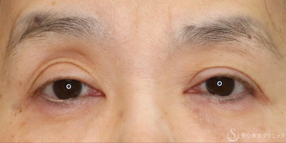 【50代女性・切らずに目の開き改善】眼瞼下垂埋没法（1ヶ月後） Before 名古屋+眼瞼下垂　埋没法