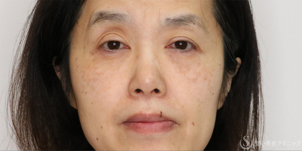 【50代女性・切らずに目の開き改善】眼瞼下垂埋没法（1ヶ月後） Before 名古屋+眼瞼下垂　埋没法
