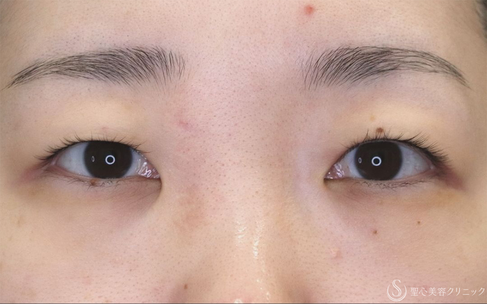 【20代女性・切開法で二重に】二重切開（1ヶ月後） Before 