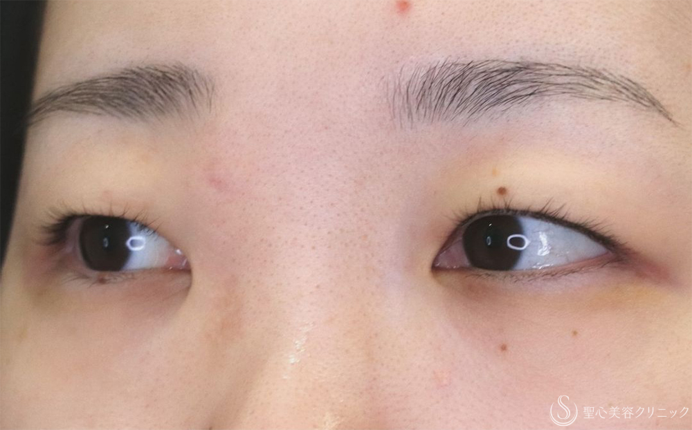 【20代女性・切開法で二重に】二重切開（1ヶ月後） Before 