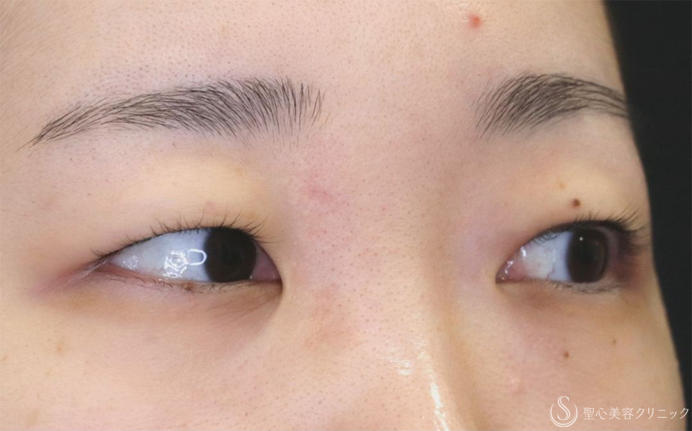 【20代女性・切開法で二重に】二重切開（1ヶ月後） Before 