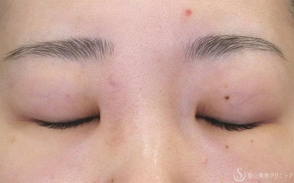 【20代女性・切開法で二重に】二重切開（1ヶ月後） Before 