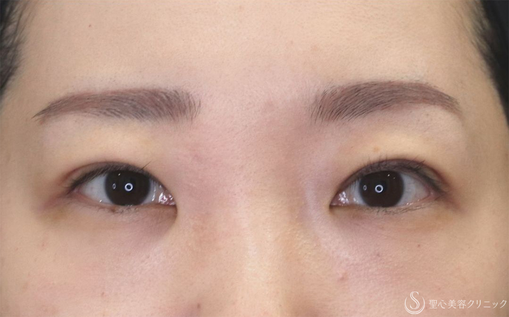【20代女性・切開法で二重に】二重切開（1ヶ月後） After 