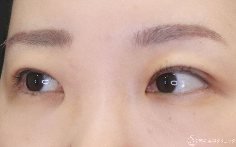 【20代女性・切開法で二重に】二重切開（1ヶ月後） After 