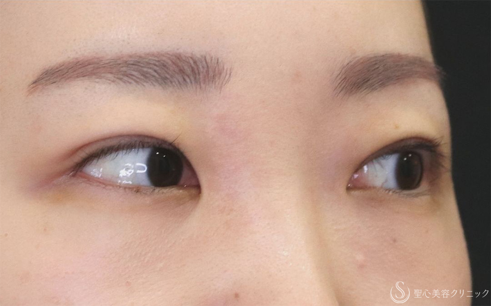 【20代女性・切開法で二重に】二重切開（1ヶ月後） After 