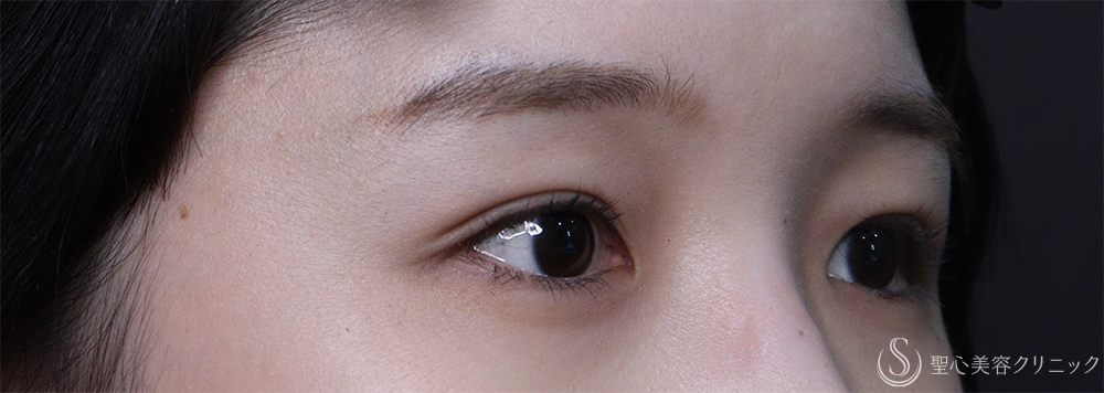 【20代女性・二重】マイクロメソッド3点（1ヶ月後） After 