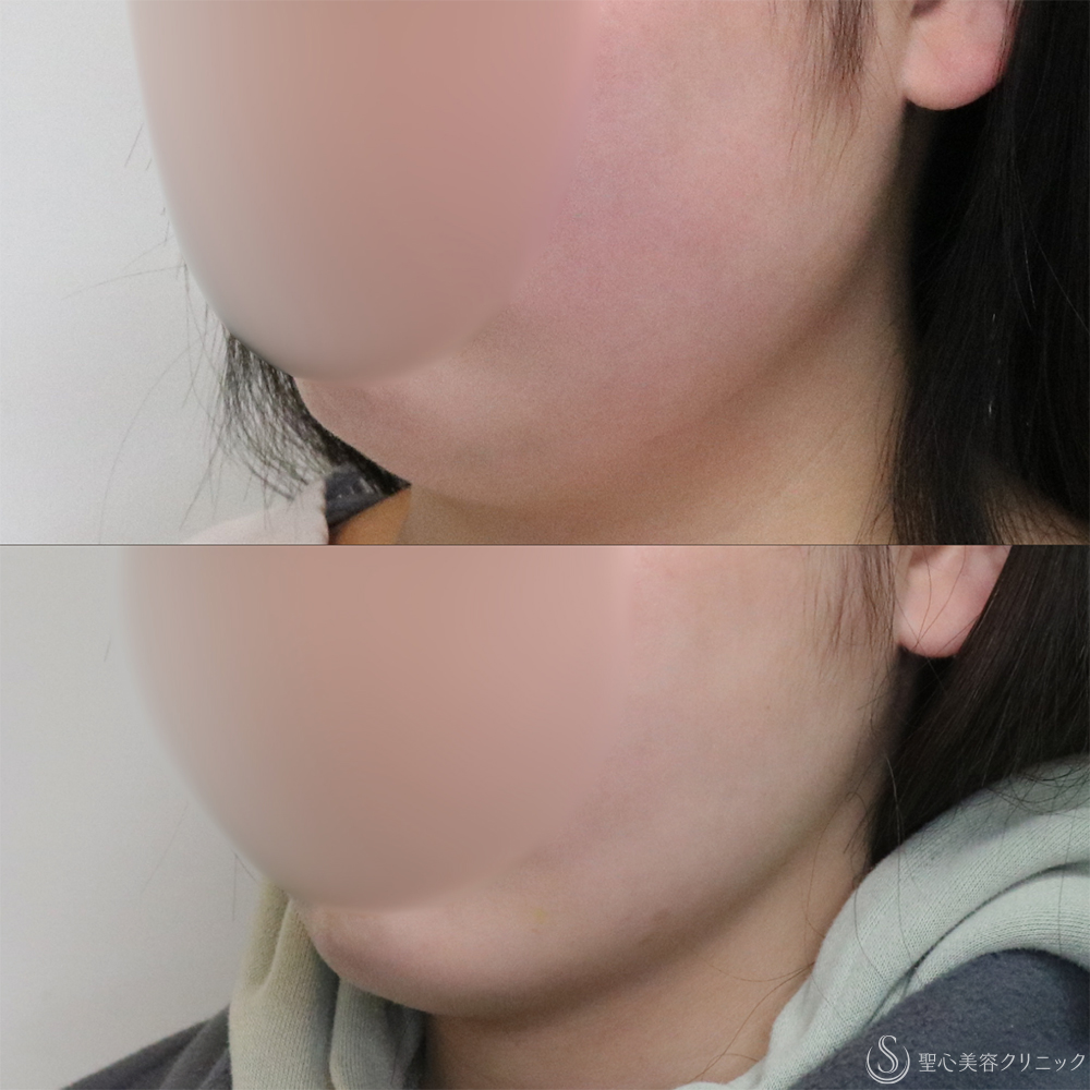 【20代女性・フェイスラインと二重顎がスッキリ】脂肪吸引（頬・顎下）（2ヶ月後） After 名古屋+たるみ　もたつき　アンチエイジング