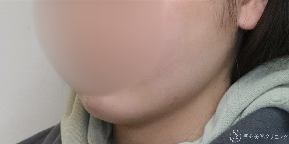 【20代女性・フェイスラインと二重顎がスッキリ】脂肪吸引（頬・顎下）（2ヶ月後） After 名古屋+たるみ　もたつき　アンチエイジング