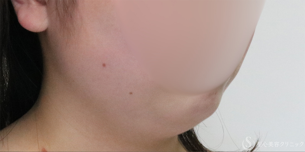 【20代女性・フェイスラインと二重顎がスッキリ】脂肪吸引（頬・顎下）（2ヶ月後） Before 名古屋+たるみ　もたつき　アンチエイジング