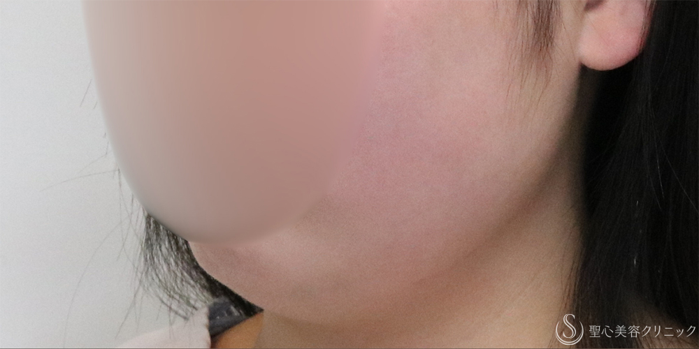 【20代女性・フェイスラインと二重顎がスッキリ】脂肪吸引（頬・顎下）（2ヶ月後） Before 名古屋+たるみ　もたつき　アンチエイジング