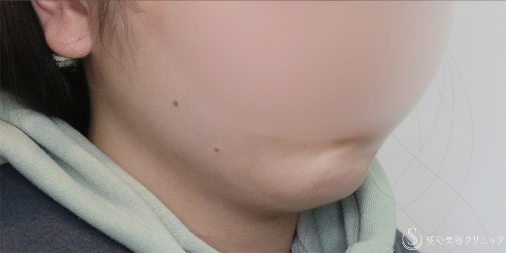 【20代女性・フェイスラインと二重顎がスッキリ】脂肪吸引（頬・顎下）（2ヶ月後） After 名古屋+たるみ　もたつき　アンチエイジング