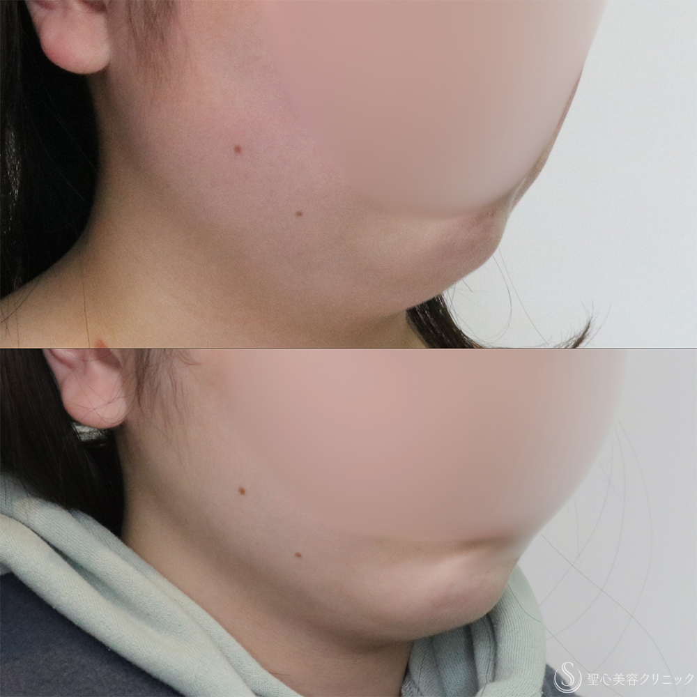 【20代女性・フェイスラインと二重顎がスッキリ】脂肪吸引（頬・顎下）（2ヶ月後） After 名古屋+たるみ　もたつき　アンチエイジング