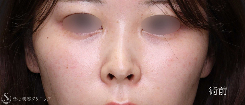 【20代女性・鼻の穴の形を自然に整える】 鼻孔縁下降術（1ヶ月後） Before 