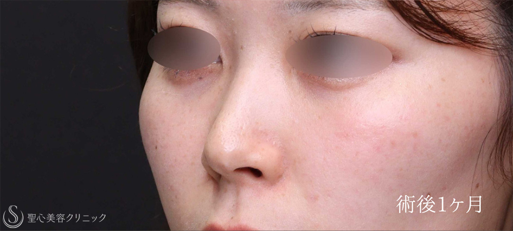 【20代女性・鼻の穴の形を自然に整える】 鼻孔縁下降術（1ヶ月後） After 