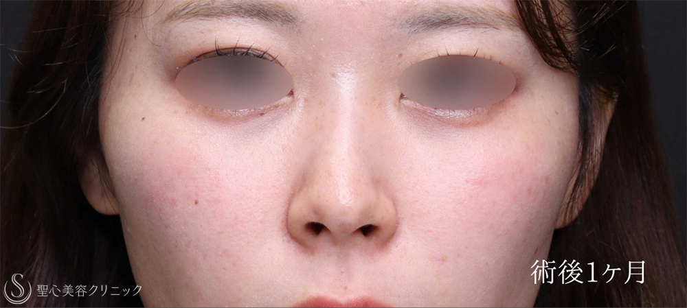 【20代女性・鼻の穴の形を自然に整える】 鼻孔縁下降術（1ヶ月後） After 