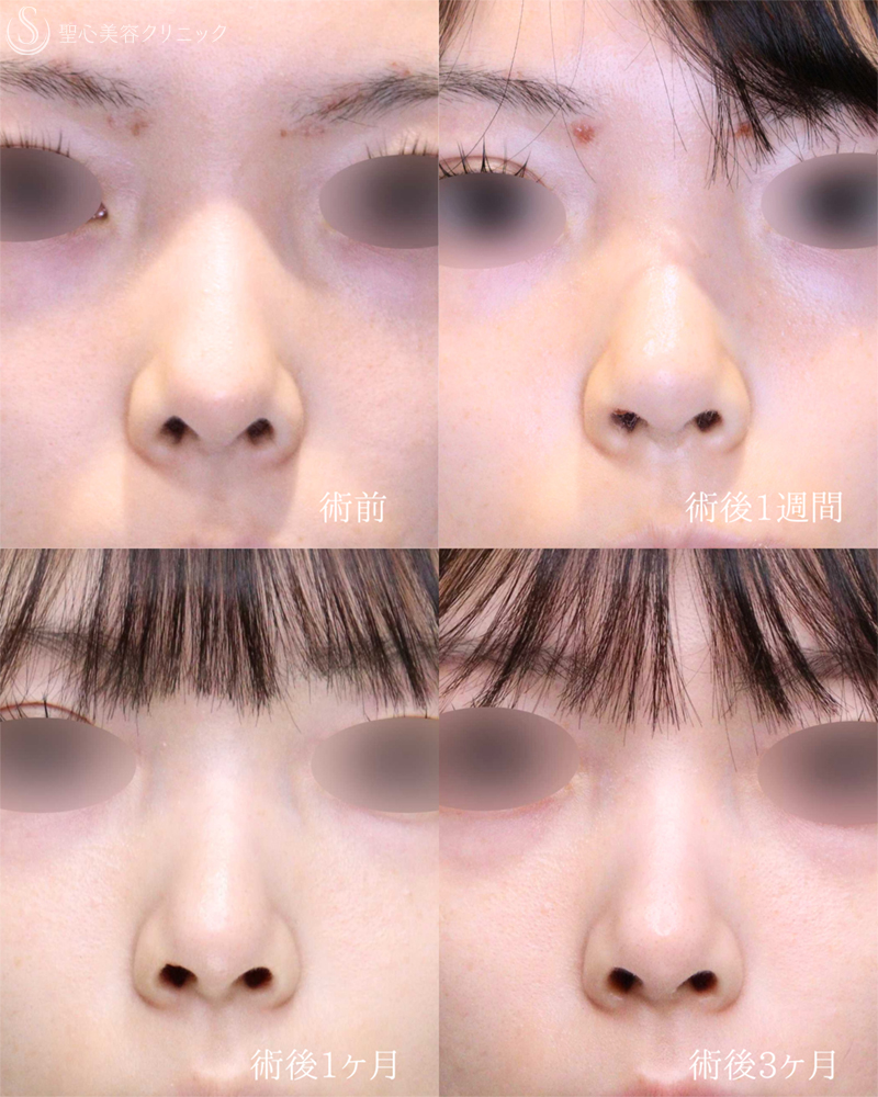 【20代女性・鼻の穴のとがりと目立つ耳介軟骨を改善】鼻孔縁下降術（3ヶ月後） After 