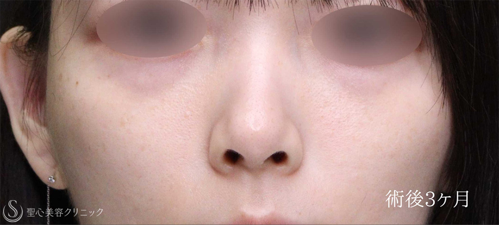 【20代女性・鼻の穴のとがりと目立つ耳介軟骨を改善】鼻孔縁下降術（3ヶ月後） After 