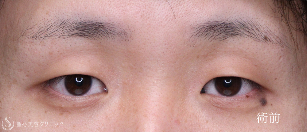 【20代男性・二重にせずに目を大きく見せる最適解】眉下リフト＋目頭切開（3ヶ月後） Before 