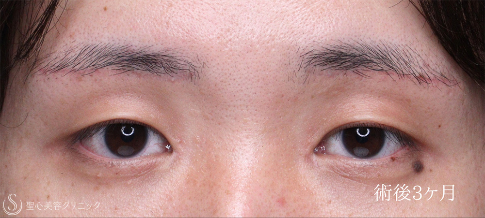 【20代男性・二重にせずに目を大きく見せる最適解】眉下リフト＋目頭切開（3ヶ月後） After 