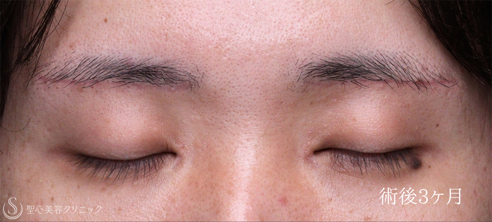 【20代男性・二重にせずに目を大きく見せる最適解】眉下リフト＋目頭切開（3ヶ月後） After 