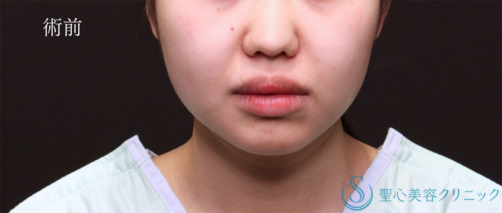 【20代女性・脂肪吸引で洗練された輪郭へ】脂肪吸引（1ヶ月後） Before 