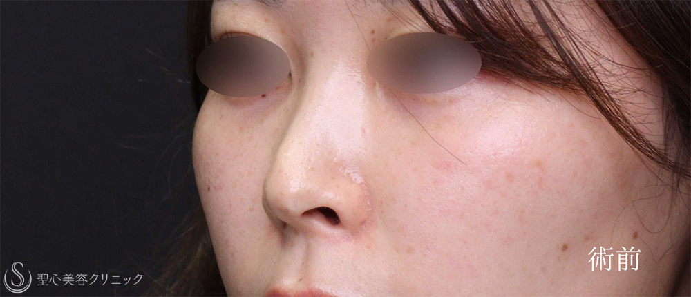 【20代女性・鼻の穴の形を自然に整える】 鼻孔縁下降術（1ヶ月後） Before 
