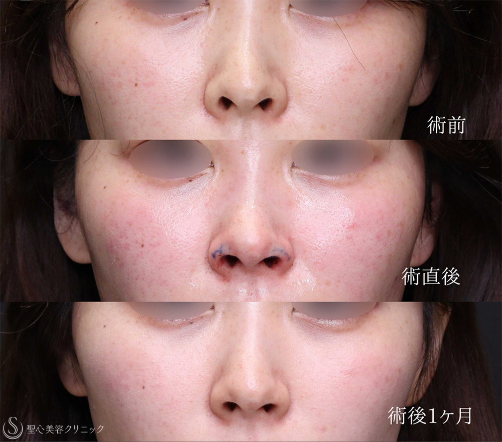 【20代女性・鼻の穴の形を自然に整える】 鼻孔縁下降術（1ヶ月後） After 