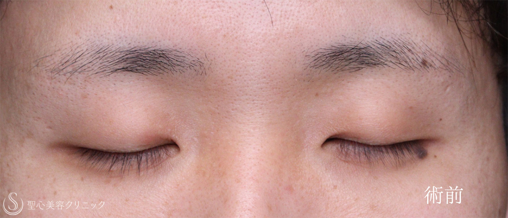 【20代男性・二重にせずに目を大きく見せる最適解】眉下リフト＋目頭切開（3ヶ月後） Before 