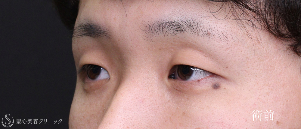 【20代男性・二重にせずに目を大きく見せる最適解】眉下リフト＋目頭切開（3ヶ月後） Before 