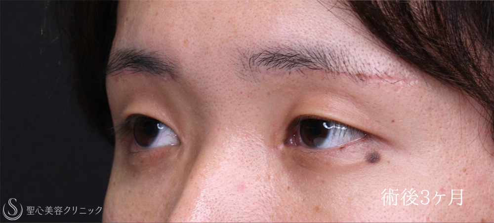 【20代男性・二重にせずに目を大きく見せる最適解】眉下リフト＋目頭切開（3ヶ月後） After 
