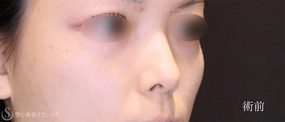 【20代女性・鼻の穴のとがりと目立つ耳介軟骨を改善】鼻孔縁下降術（3ヶ月後） Before 