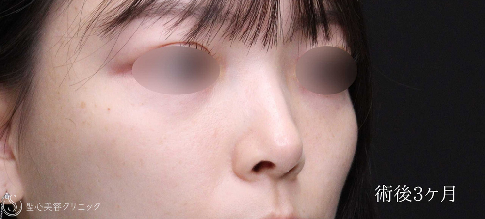 【20代女性・鼻の穴のとがりと目立つ耳介軟骨を改善】鼻孔縁下降術（3ヶ月後） After 