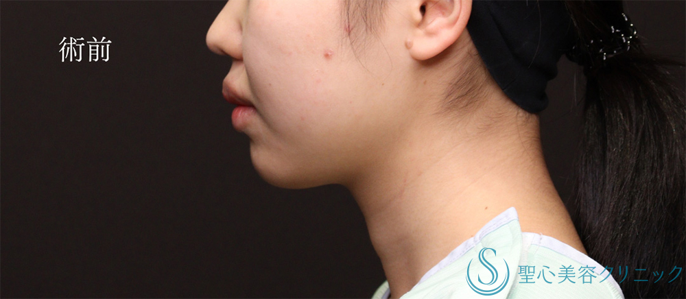 【20代女性・脂肪吸引で洗練された輪郭へ】脂肪吸引（1ヶ月後） Before 